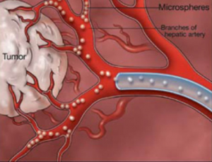 What Is Transarterial Chemoembolization (TACE)