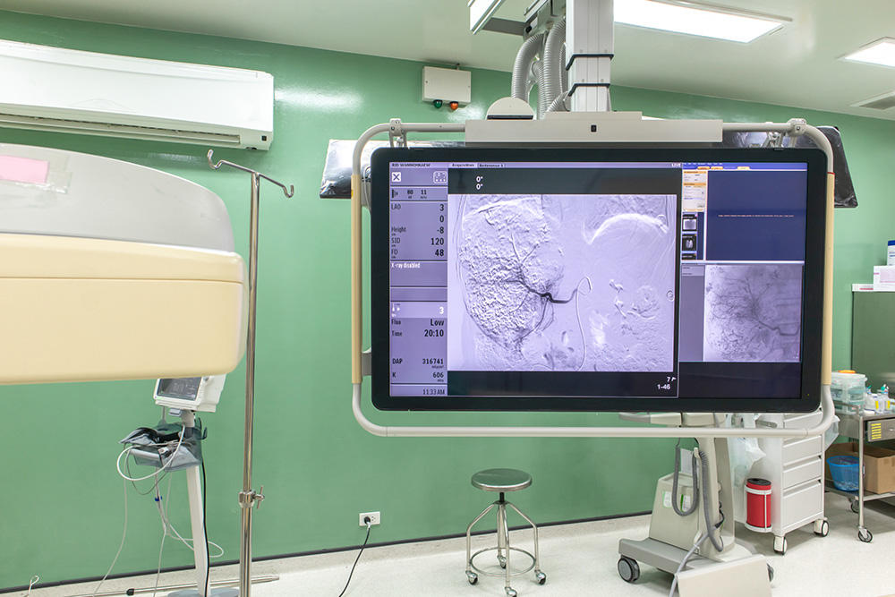 Transarterial Chemoembolization (TACE)