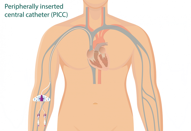Liver Cancer Treatments Central Venous Access Devices