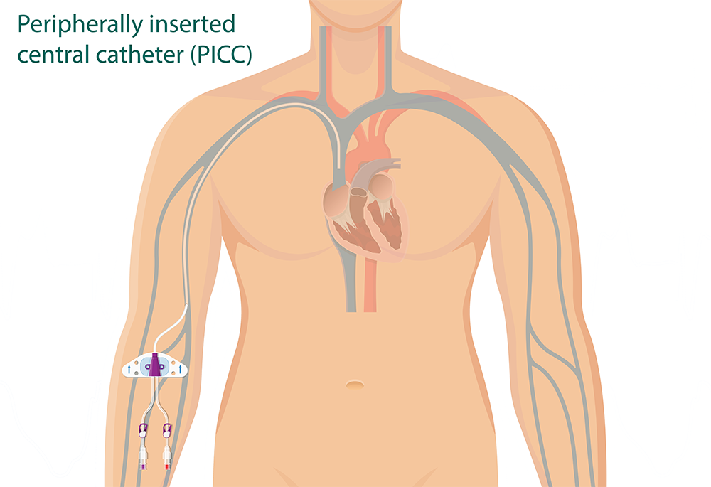 Peripherally Inserted Central Catheter (PICC)