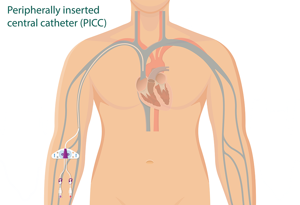 What is a Venous Access Device and What Types are Used for Cancer Patients?  - CancerConnect