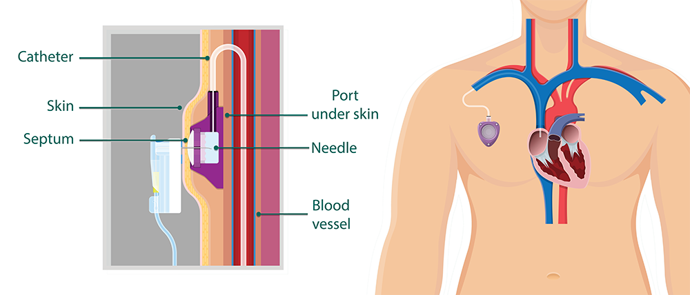 Liver Cancer Treatments - Central Venous Access Devices