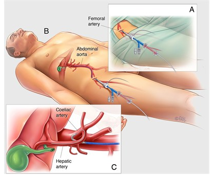 What is Radioembolization (Y-90 SIRT)