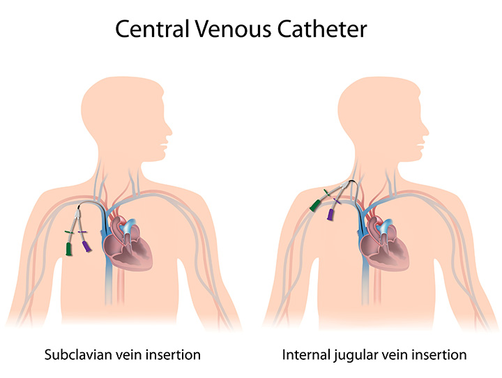 central venous catheter