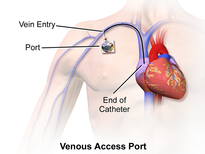 Venous Access Port