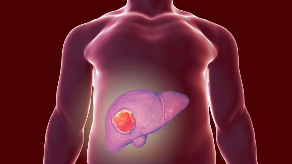 What is the Difference Between Liver Disease, Cancer, and Failure
