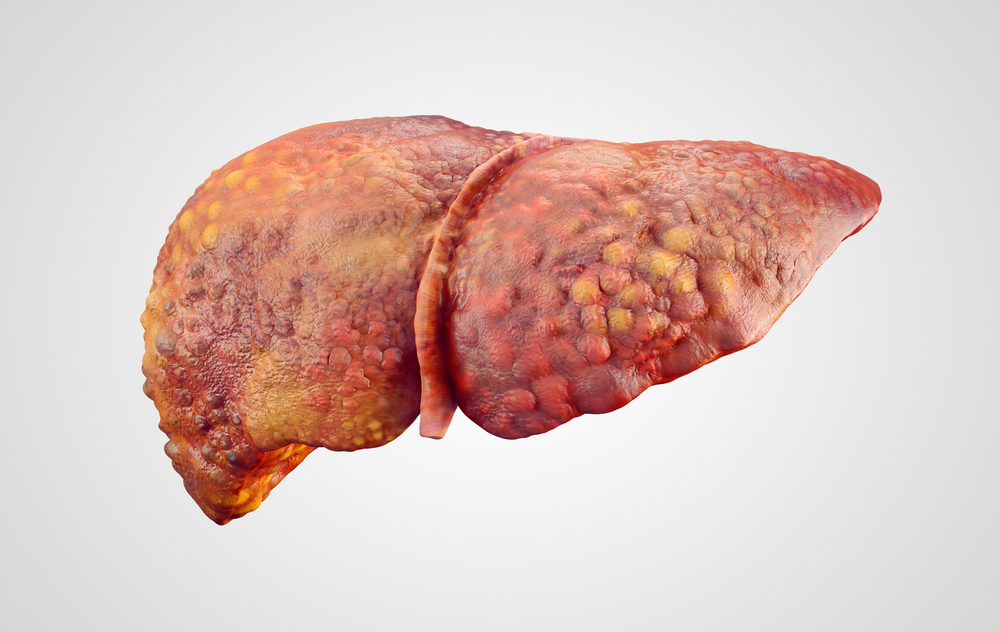 liver cancer treatment NY