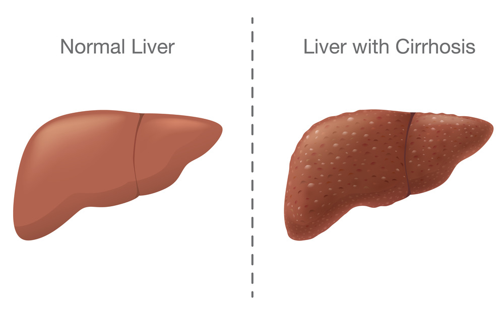 normal liver versus liver with cirrhosis