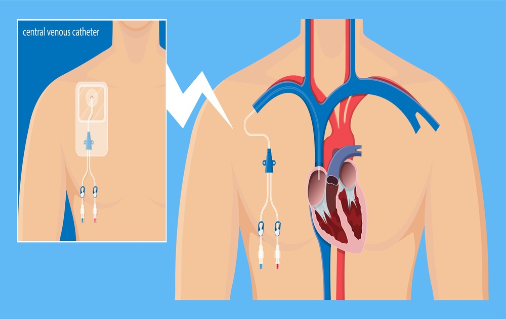 tunneled central venous catheter