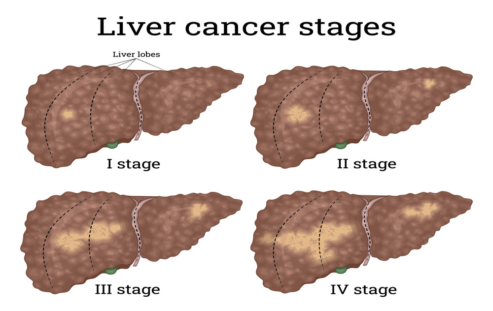 The Different Stages of Liver Cancer
