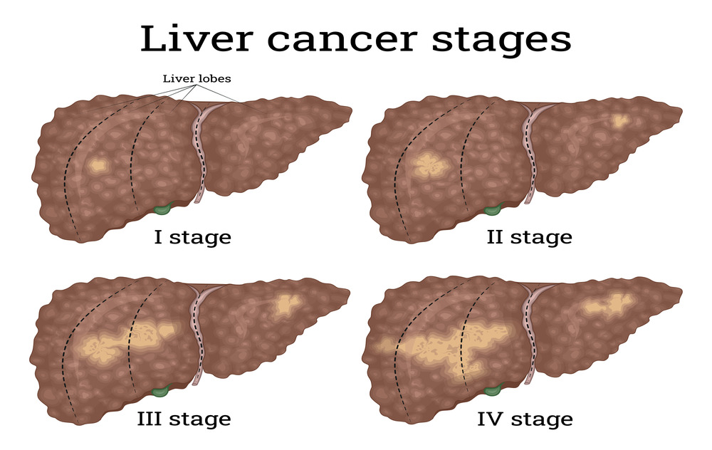 stages of liver cancer