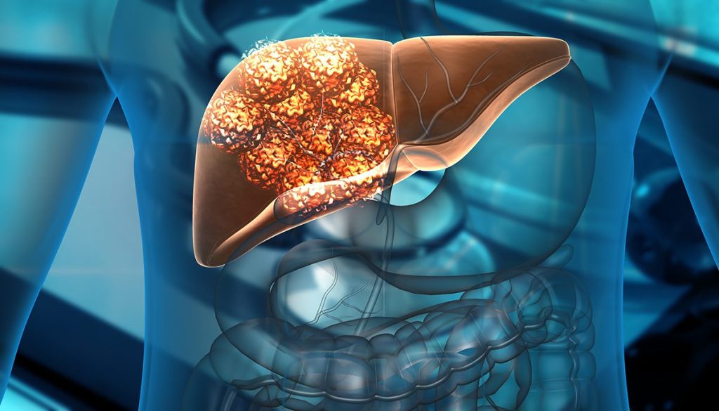 5 bad habits that increase your risk of liver cancer