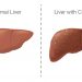 liver cancer treatment New York