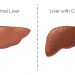 normal liver versus liver with cirrhosis